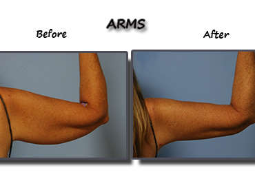 Jiggly Flabby Arms Reduced With Laser Liposuction