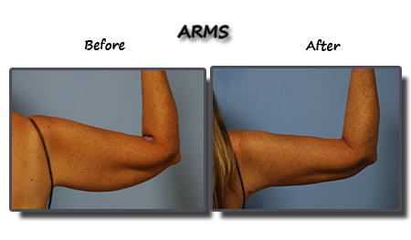Jiggly Flabby Arms Reduced With Liposuction - Body Envi